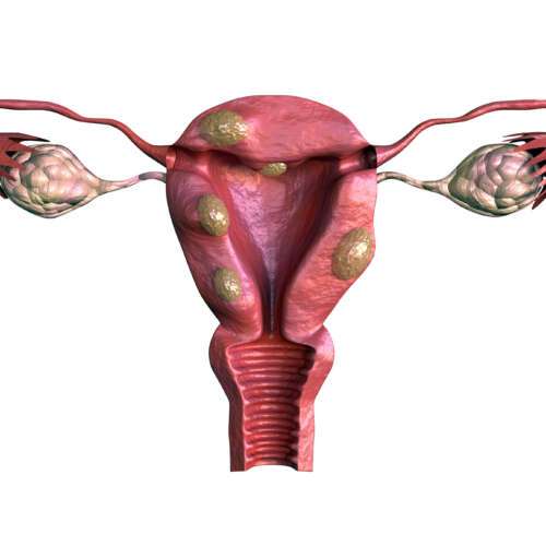 fibroids