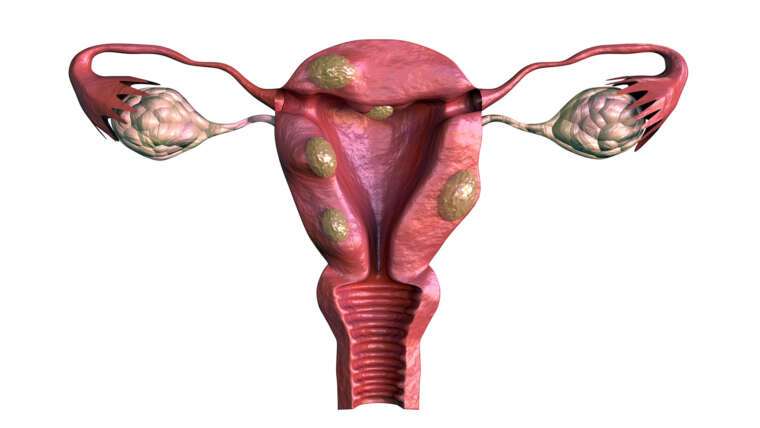 fibroids