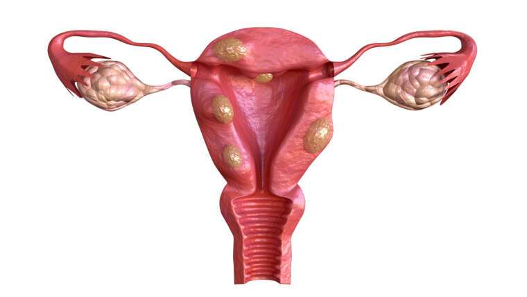 fibroids