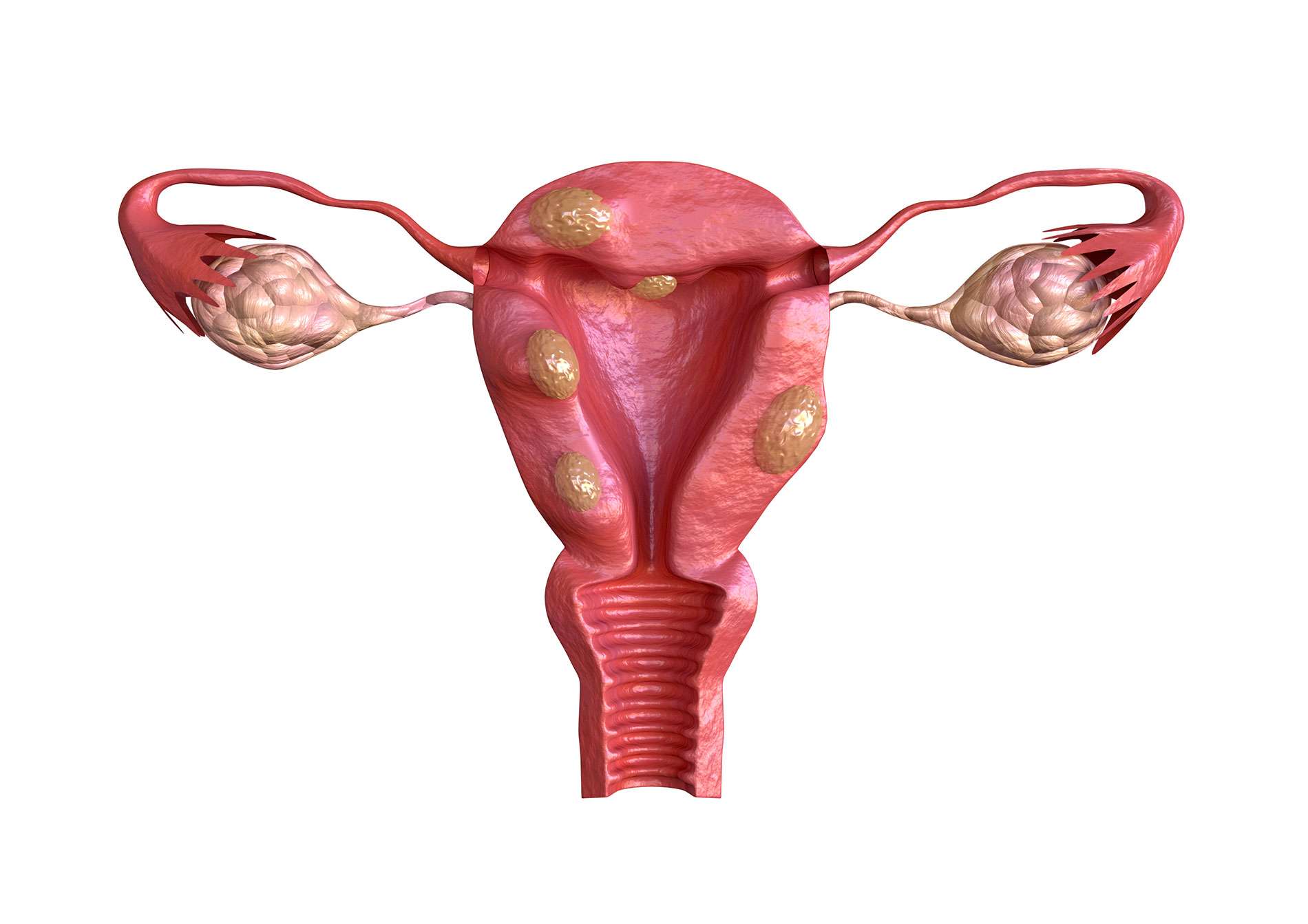 fibroids